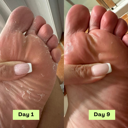LOVILDS® AntiFungal Relief Soap Bar