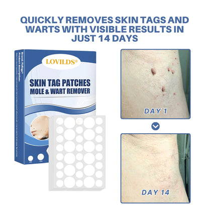 LOVILDS® Moles & Warts Removing Skin Tag Patch