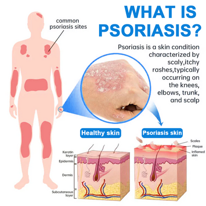 ✅  Official Store: KUBOZN® Magnesium Herbal Psoriasis Spray ⚕️