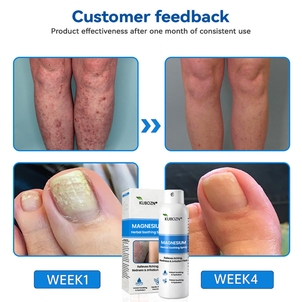 ✅  Official Store: KUBOZN® Magnesium Herbal Psoriasis Spray ⚕️