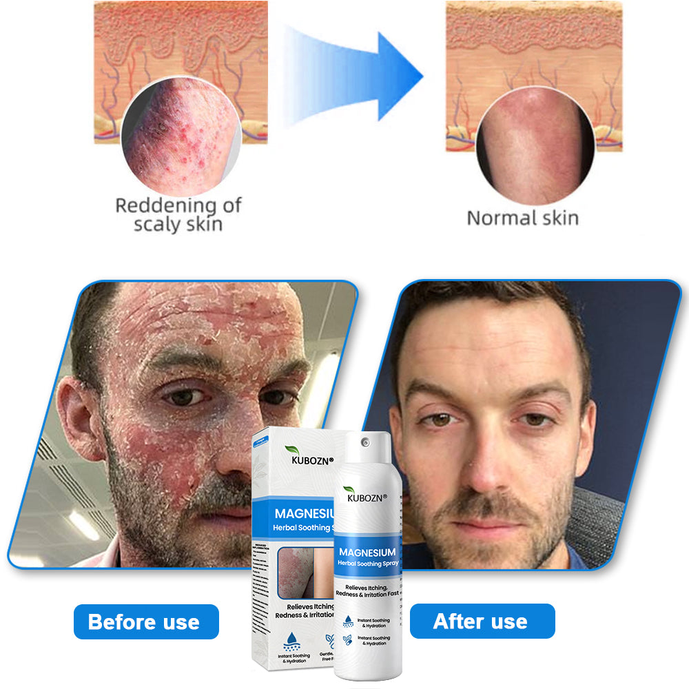 ✅  Official Store: KUBOZN® Magnesium Herbal Psoriasis Spray ⚕️