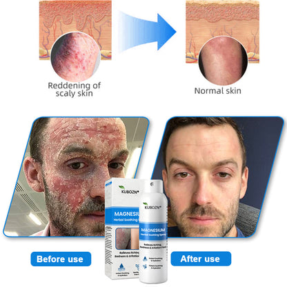 ✅  Official Store: KUBOZN® Magnesium Herbal Psoriasis Spray ⚕️