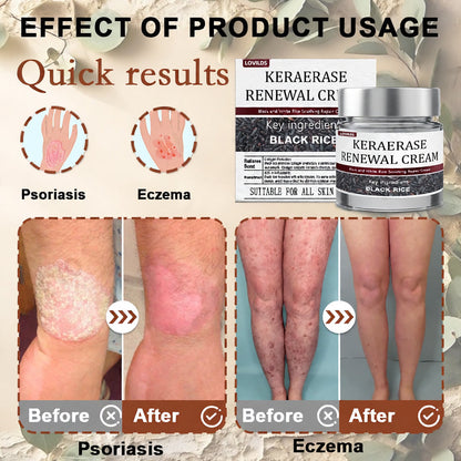 ✅Flash Sale - LOVILDS®KeraErase Dual-Action Renewal Cream